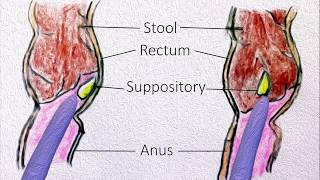 Rectal Suppositories  How to use them [upl. by Nester]