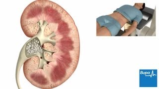 How extracorporeal shockwave lithotripsy is used to treat kidney stones  Bupa Health [upl. by Andrey]