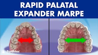 Rapid PALATAL expander MARPE  This ORTHODONTIC device can EXPAND the PALATE in adults© [upl. by Eugatnom]