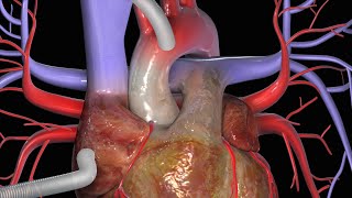 KoronararterienBypass CABG [upl. by Edson667]