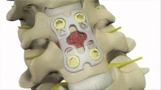 Anterior Cervical Discectomy and Fusion  DePuy Videos [upl. by Blasien]