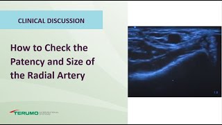 How to Check the Patency and Size of the Radial Artery  Terumo Interventional Systems [upl. by Katinka]