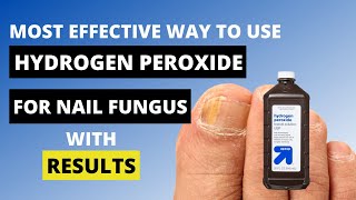 3 Ways to Use Hydrogen Peroxide for Nail Fungus  Toe Fungus Journey [upl. by Aicinat]