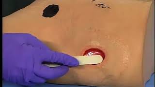 Wound Filler Dressing Application and Removal [upl. by Poland]