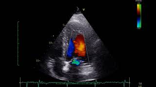 ECOCARDIOGRAMA DOPPLER COLOR [upl. by Droffilc]