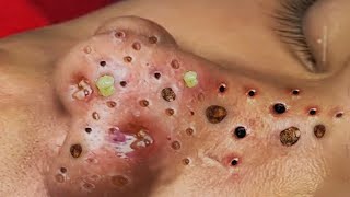 Big Cystic Acne Blackheads Extraction Blackheads amp Milia Whiteheads Removal Pimple Popping 122 [upl. by Teece855]