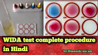 WIDAL test Complete procedure in hindi WIDAL test  how to perform WIDAL test  WIDAL test kese kre [upl. by Mozelle]