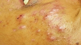 Enlever les points noirs les microkystes et un acné kystique a cystic acne [upl. by Berners]