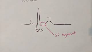 Acute Coronary Syndrome USA vs NSTEMI vs STEMI [upl. by Sisson]