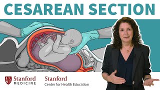 What is a cesarean section OBGYN answers 13 common questions about csections  Stanford [upl. by Ful645]