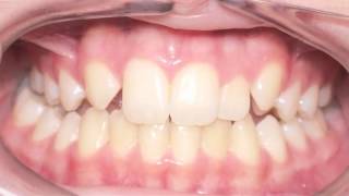 Canine Substitution Missing Lateral Incisor Kyger Orthodontics [upl. by Aniar881]