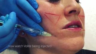 Volite InjectionsSkinboosters [upl. by Alake]