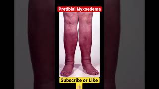 Pretibial Myxoedema [upl. by Alfonso95]