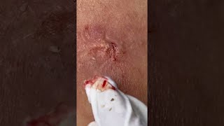 Big Cystic Acne Blackheads Extraction Blackheads amp Milia Whiteheads Removal Pimple Popping shorts [upl. by Tucky]