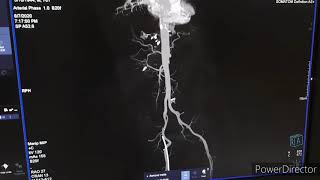 Ct Abdominal Angio Aortic Angiography [upl. by Geddes]