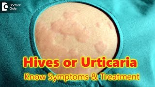 Hives  UrticariaCausesSymptomsTreatment  Skin Rash  Allergy  DrRasya Dixit  Doctors Circle [upl. by Lauhsoj]