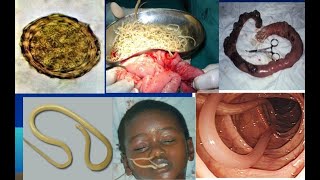 Ascaris Lumbricoides Ascariasis Morphology  Life cycle  Pathogesis  Treatment  Parasitology [upl. by Biddick521]