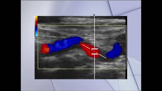 Ultrasonido Doppler Finalmente Explicado [upl. by Airdnua]