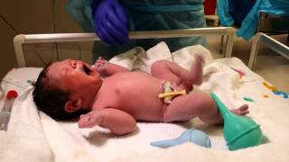 Baby 3 Live Birth in 4K UHD Video Csection Operation Delivery camera recording [upl. by Corbie405]