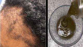 HERBAL oil This hair growth recipe will be your last stopApply 3x a week grow ya hair 10X faster [upl. by Seaton]