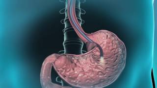 Learn about gastroscopy [upl. by Bessy364]