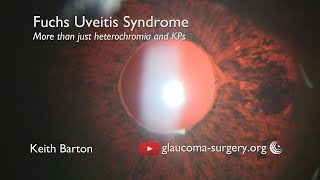 Fuchs Uveitis Syndrome  The Clinical Features  More than Heterochromia and KPs [upl. by Anelagna]