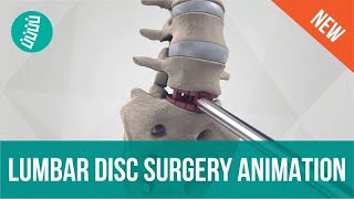 Lumbar Disc Replacement with 3rdGen Technology [upl. by Convery]