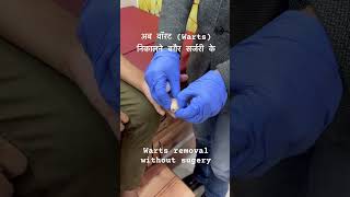 Warts removal without surgery [upl. by Leahicm]