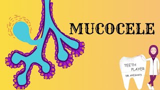 ORAL MUCOCELE  MUCOUS EXTRAVASATION  HOW IT FORMS  CLINICAL FEATURES  HISTOLOGY  TREATMENT [upl. by Nibor13]