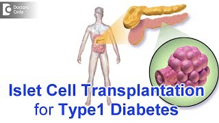 What is Islet Cell Transplant for Type1 Diabetes  Dr Anantharaman Ramakrishnan [upl. by Lossa]