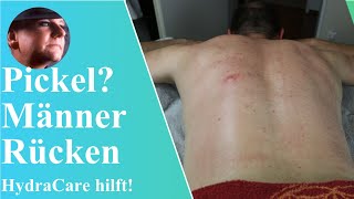 HydraCare Behandlung für Pickel und Juckreiz auf dem Männerrücken  BodyDream Kosmetikstudio [upl. by Katheryn]