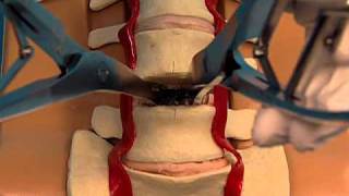 Synthes Spine ProDiscL Lumbar Total Disc Replacement Demonstration Video [upl. by Aluor]