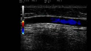 Phlebology Biosound Esaote MyLab 25 Proximal GSV with Reflux [upl. by Sinylg]