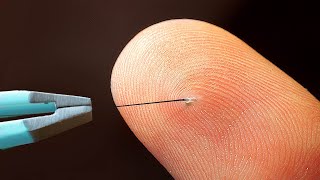 REMOVING A HAIR UNDER A MICROSCOPE [upl. by Studley]