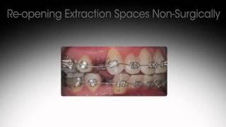 Reversing Previous Orthodontic Treatment [upl. by Novehs]