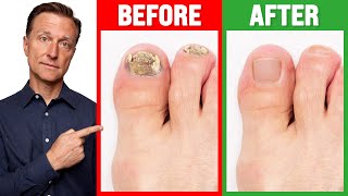 The REAL Cause of Toenail Fungus is [upl. by Rosalind]