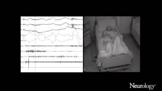 Immunotherapy of oneiric stupor in Morvan syndrome Efficacy documented by actigraphy [upl. by Evey]