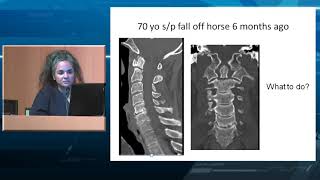 Management of Odontoid Fractures [upl. by Sorce]