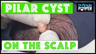 A Perfect Pilar Cyst Pop Dr Pimple Popper amp Buzzfeed [upl. by Vijnas133]