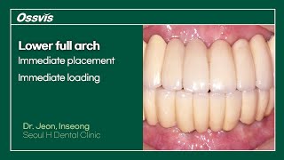 Clinical Case Lower full arch immediate placement amp loading [upl. by Nacim189]