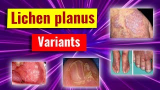 Clinical variants of lichen planus [upl. by Akerdal]