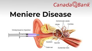 Meniere Disease [upl. by Korry]