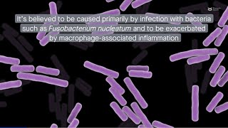 The root of the problem F nucleatum triggers cell death in apical periodontitis via ZBP1 [upl. by Etam]