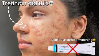 Tretinoin mistakes that ruined my skin 😫 tretinoin skincare beauty [upl. by Namor254]