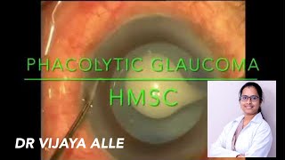 PHACOLYTIC GLAUCOMA  HYPERMATURE CATARACT  Dr VIJAYA [upl. by Ahiel352]