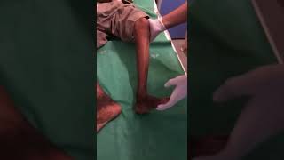 Demonstration of Sustained Ankle Clonus Dept of Medicine JNMC [upl. by Marinelli]