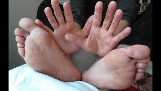 COXSACKIE VIRUS Symptoms Causes Transmission Treatment Hand Foot Mouth disease Herpangina [upl. by Rahr378]