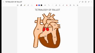 TETRALOGY OF FALLOT [upl. by Vidal983]