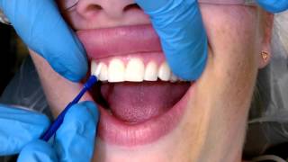 Tips For Applying Fluoride Varnish [upl. by Alomeda]