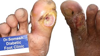 Diabetic Foot  Toe Infection  Diabetic Ulcer Before After Video Stages [upl. by Sennahoj]